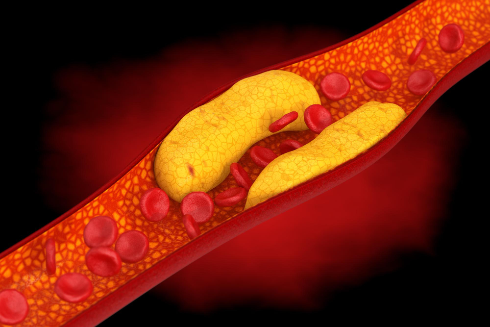 Kas lemia didelį cholesterolio kiekį?