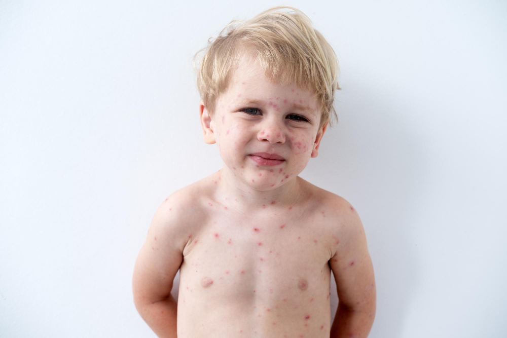 Kodėl vaikui atsiranda smulkus bėrimas?