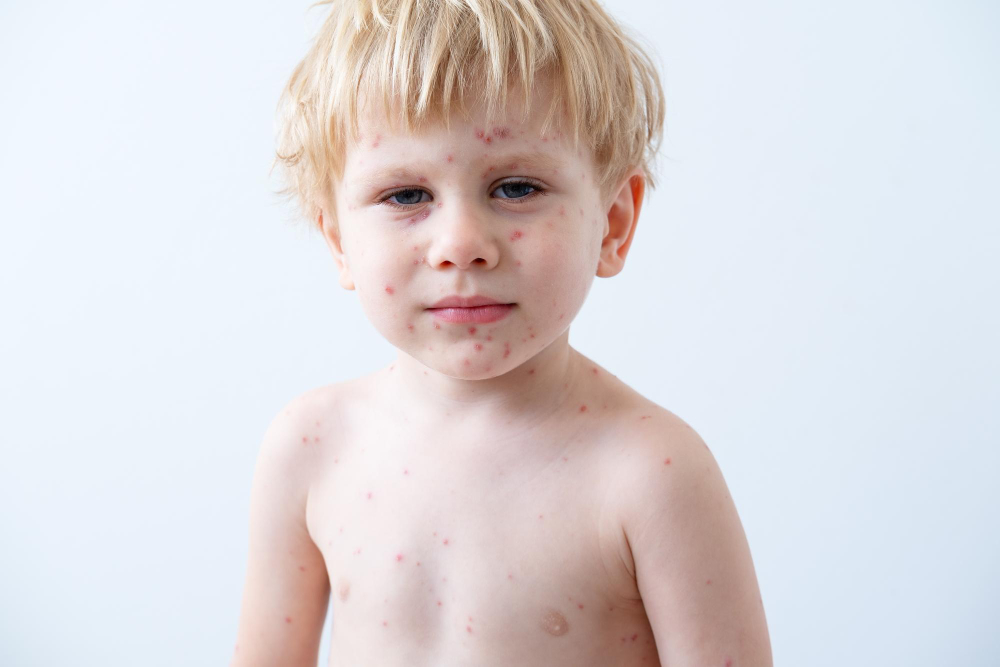 Smulkus bėrimas vaikui: kada kreiptis į gydytoją?